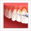 detartrage dentaire